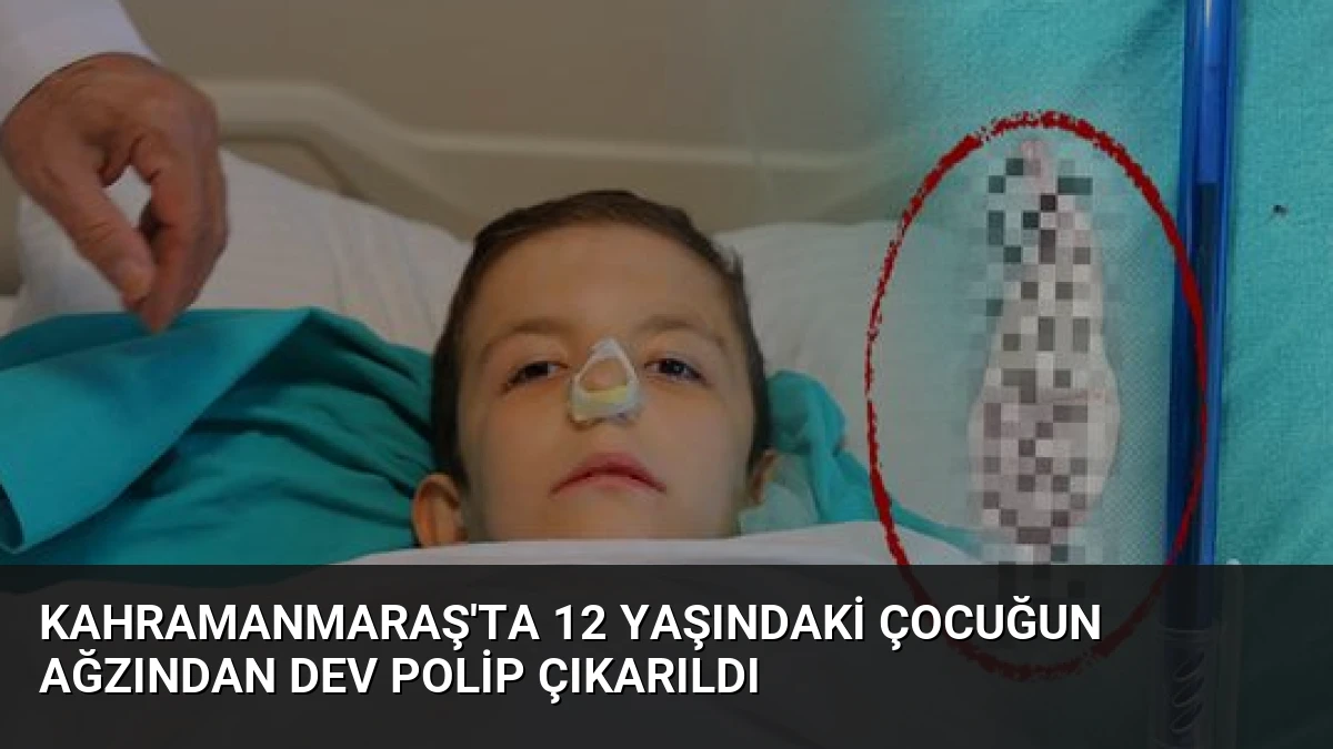 Kahramanmaraş’ta 12 Yaşındaki Çocuğun Ağzından Dev Polip Çıkarıldı